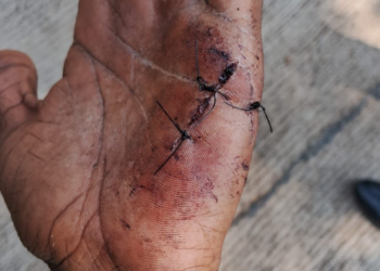 Youth Seriously Injured in Sangamwadi Attack During Holi Festivities