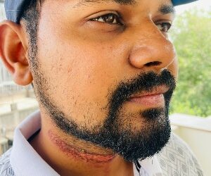 Youth Injured by Hanging Wire on Sinhagad Road PMC Flyover Contractor Blame Game Continues