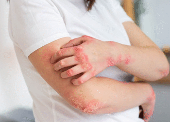 Stay Skin-Safe This Monsoon Expert Advice on Managing Common Seasonal Skin Issues